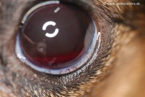 hyphema