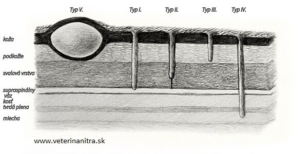 Dermoid sinus (DS)